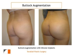 Buttock enlargement with silicone implants