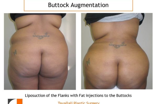 BBL Brazilian buttock lift fat injection for buttock enlargement