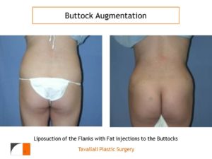BBL Brazilian buttock lift enlargement results