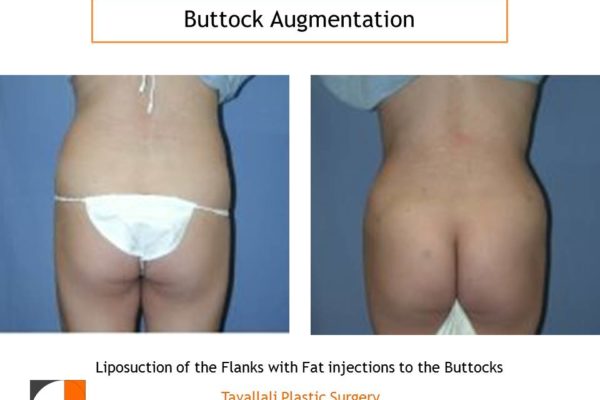 BBL Brazilian buttock lift enlargement results