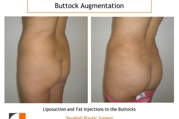 BBL Brazilian buttock lift before after