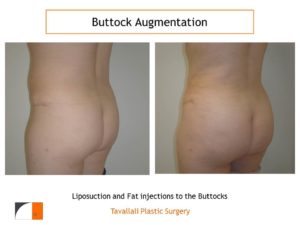 BBL Brazilian buttock lift fat injection to buttocks before after