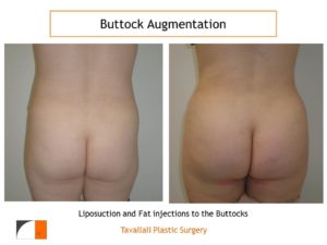 BBL Brazilian buttock lift before after surgery