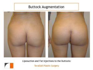 BBL Brazilian buttock lift fat injection to buttocks