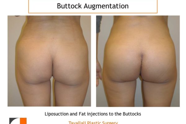 BBL Brazilian buttock lift fat injection to buttocks