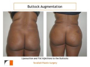 BBL Brazilian buttock lift fat injection for round full buttocks