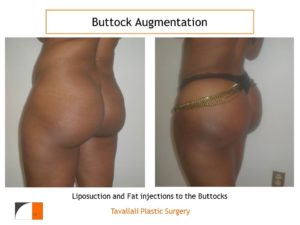 BBL Brazilian buttock lift before after rounded buttocks