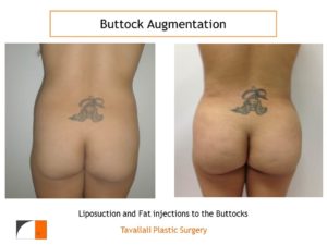 BBL Brazilian buttock lift fat injection result