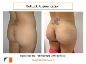 BBL Brazilian buttock lift fat injection results