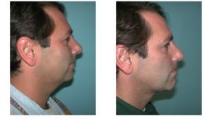 Chin Augmentation before after in man