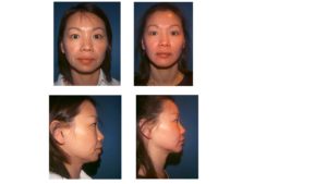 Chin Surgery Before & After in woman