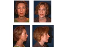 Chin Implant augmentation before after
