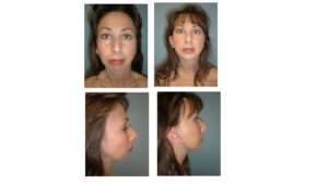 Chin Surgery enlargement with implant