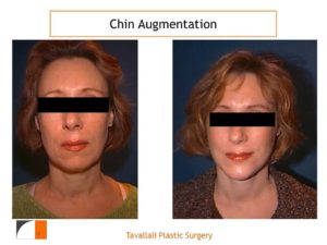 Chin Implant Surgery result