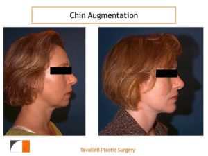Chin Implant result in profile