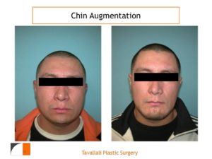 Chin Augmentation at Tavallali Plastic Surgery