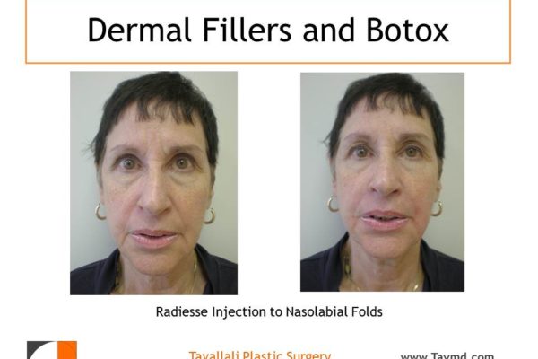 Radiesse dermal filler injection to nasolabial folds before after