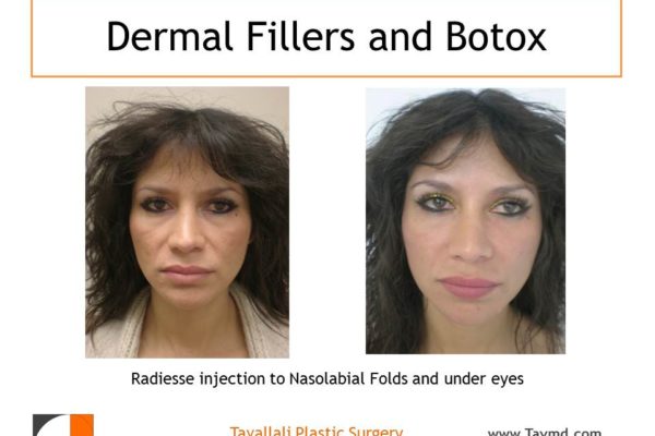 Before After Belotero radiesse botox to facial lines northern VA
