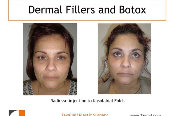 Dermal skin filler Radiesse injection to face before after