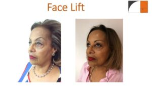 Mini facelift plastic surgery before after photo northern virginia