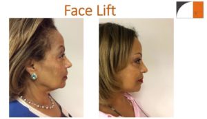 Profile before after face lift surgery