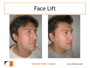 Before after of facelift surgery for acne