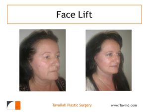 Facelift surgery results of woman