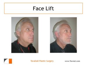 Man before after face lift surgery