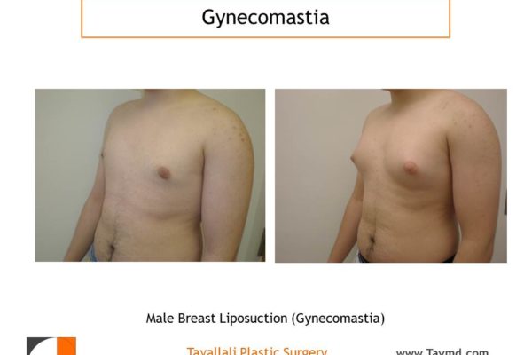 Male breast reduction Gynecomastia with liposuction