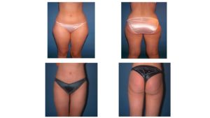 Outer thigh and hip liposuction results VA