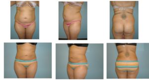 Three views liposuction abdomen and flanks before after