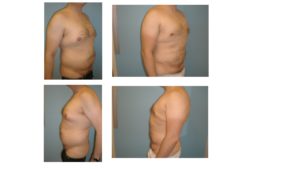 man with liposuction abdomen chest and flanks before after