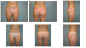 liposuction abdomen and flanks before after