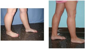 Lower leg lipo before after