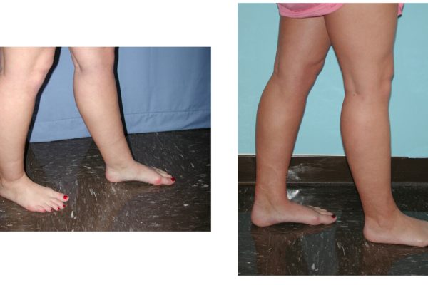 Lower leg lipo before after