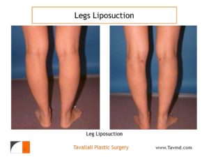 Leg liposuction surgery before after result