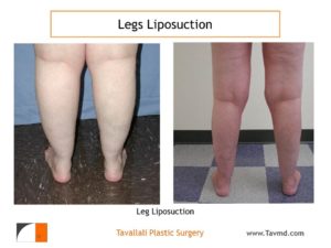 Leg liposuction before after surgery result