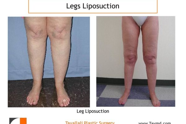 leg liposuction results in VA