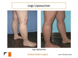 leg liposuction before after result