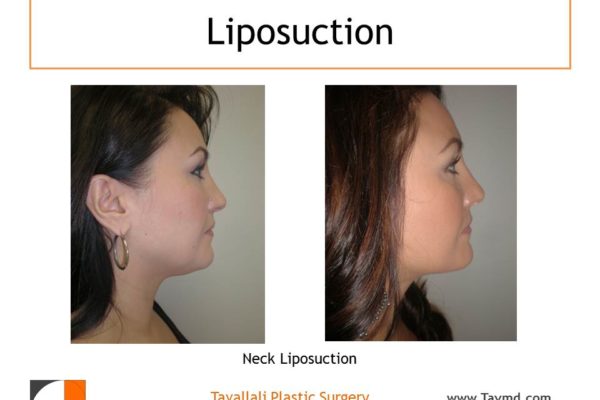 profile of woman before after neck liposuction Fairfax county VA