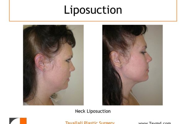 Profile view before after neck liposuction Fairfax county VA