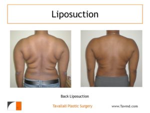 Liposuction back folds before after