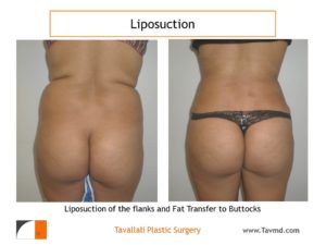 BBL Brazilian buttock lift liposuction fat transfer
