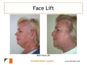 Mini facelift surgery profile
