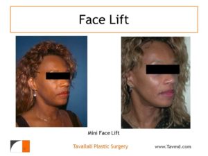 Mini facelift surgery results before and after