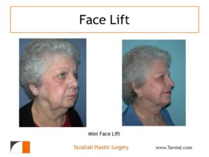 Mini facelift before after of woman with jowls