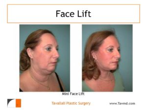 Woman with mini Face lift