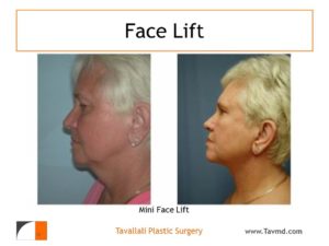 Neck lift before after surgery