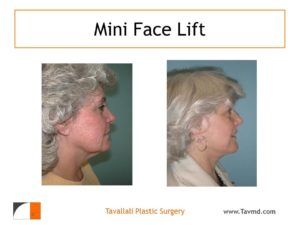 Woman with mini face lift surgery