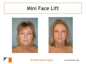 Young woman before after mini facelift